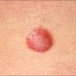 Example of skinLumpsAndBumps